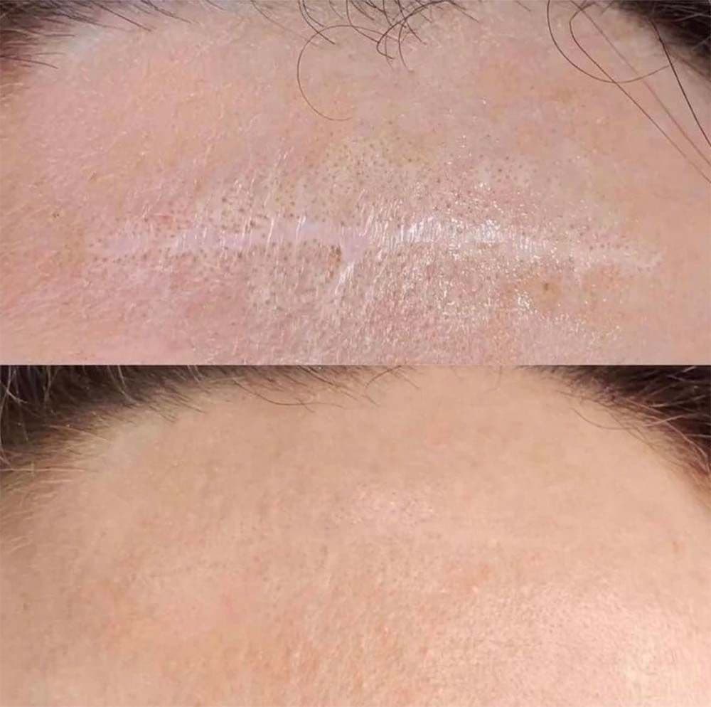 Camuflaje de cicatrices